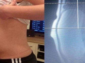 Νόμιζαν ότι αυτή η 17χρονη έφηβη ήταν έγκυος… Όταν όμως οι γιατροί είδαν την αξονική της «πάγωσαν» (photo)