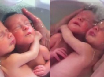 Δίδυμα δεν έχουν καταλάβει ότι γεννήθηκαν και παραμένουν αγκαλιασμένα όπως ήταν μέσα στην κοιλιά της μαμάς τους